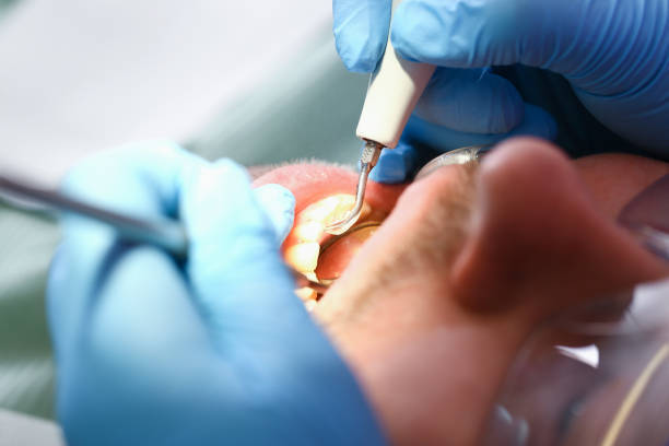 Best Emergency Root Canal Therapy in Long Grove, IL