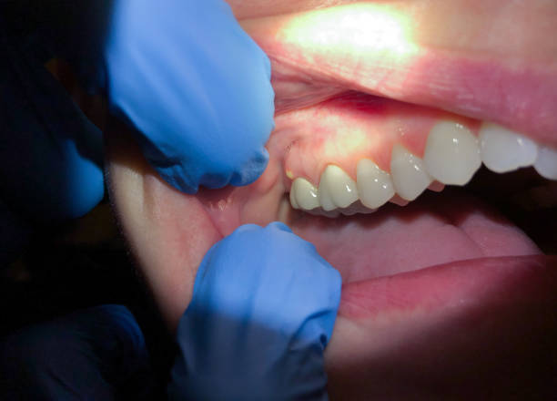 Best Emergency Wisdom Tooth Extraction in Long Grove, IL
